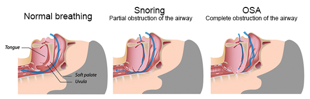 how to stop snoring - statewide home health care